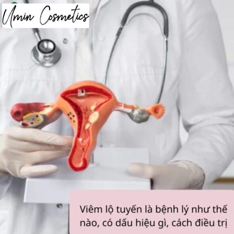 Viêm lộ tuyến